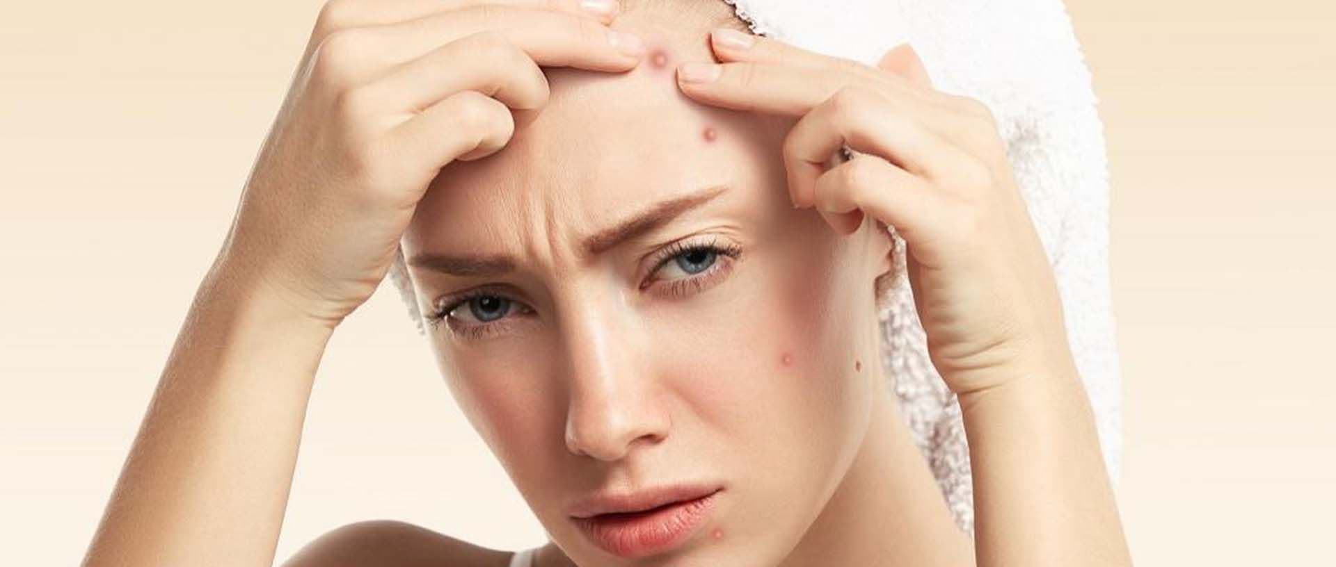 Hati-Hati! 5 Kebiasaan Ini Bisa Membuat Jerawat Betah Di Wajahmu