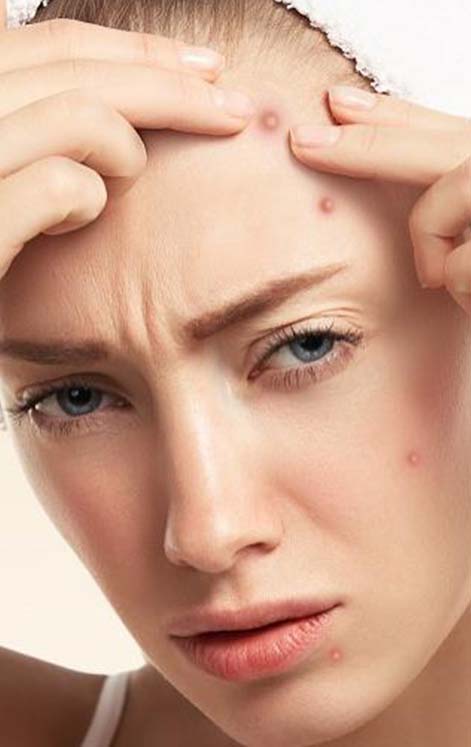 Hati-Hati! 5 Kebiasaan Ini Bisa Membuat Jerawat Betah Di Wajahmu